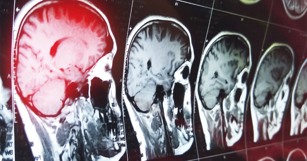 Contact Our St. Clair County Car Wreck Lawyers at The Cates Law Firm if You Have a Brain Injury From a Crash